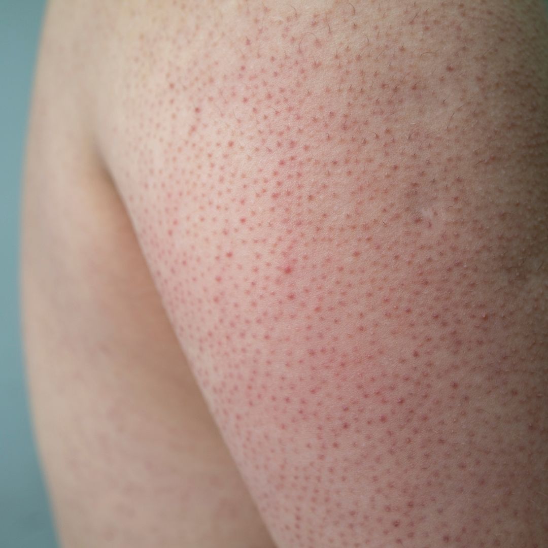 peau de fraise sur les bras ou keratose pilaire