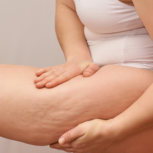 Cellulite et minceur naturelle : le guide complet pour une peau lisse et tonique