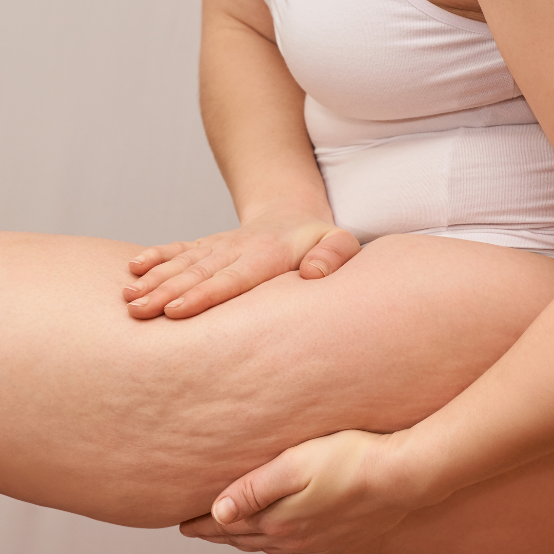 Cellulite et minceur naturelle