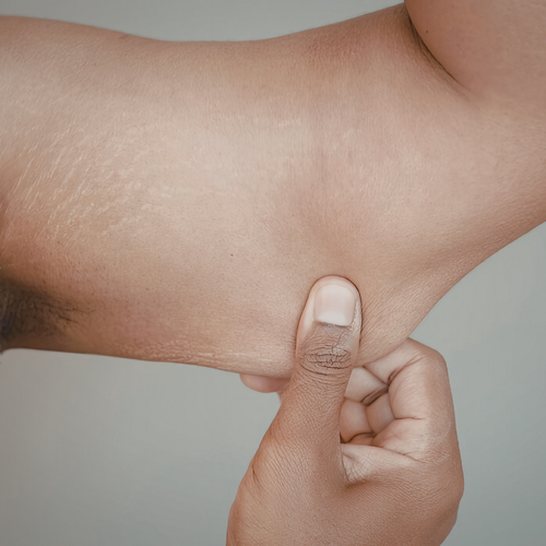 Peau flasque après un régime : comment raffermir naturellement sa peau ?