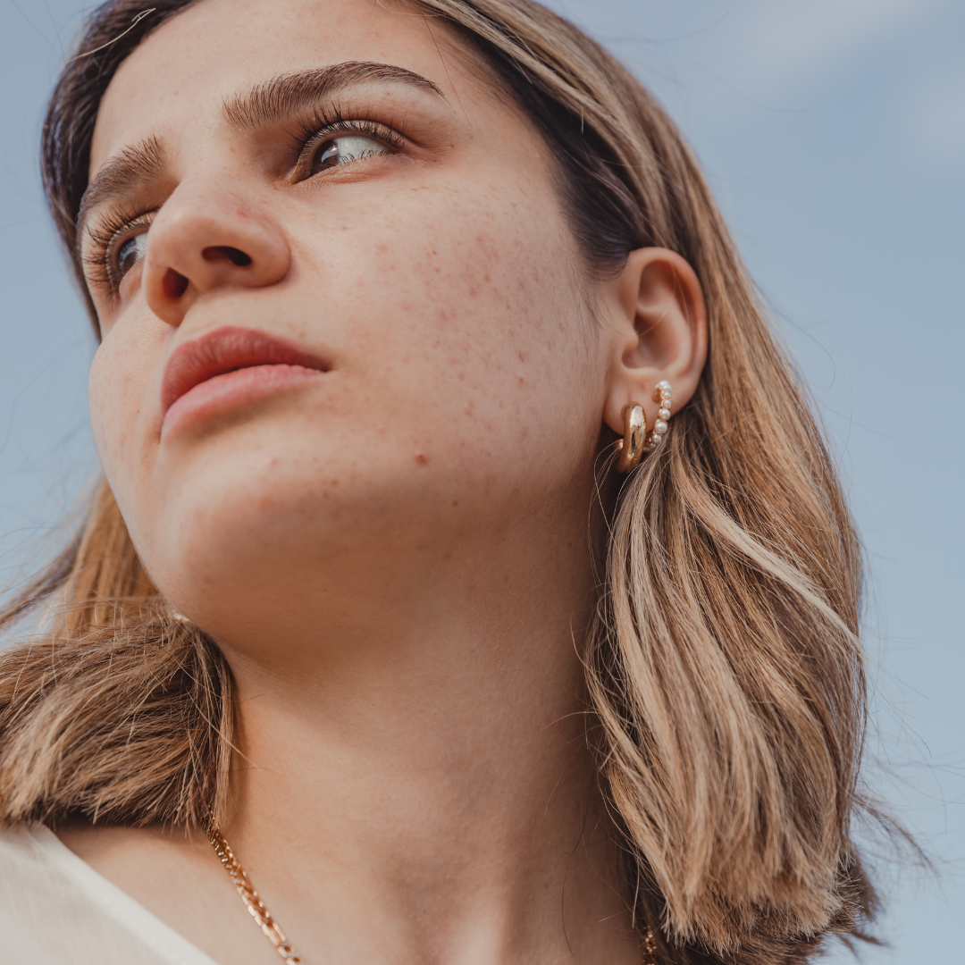 acné hormonale femme