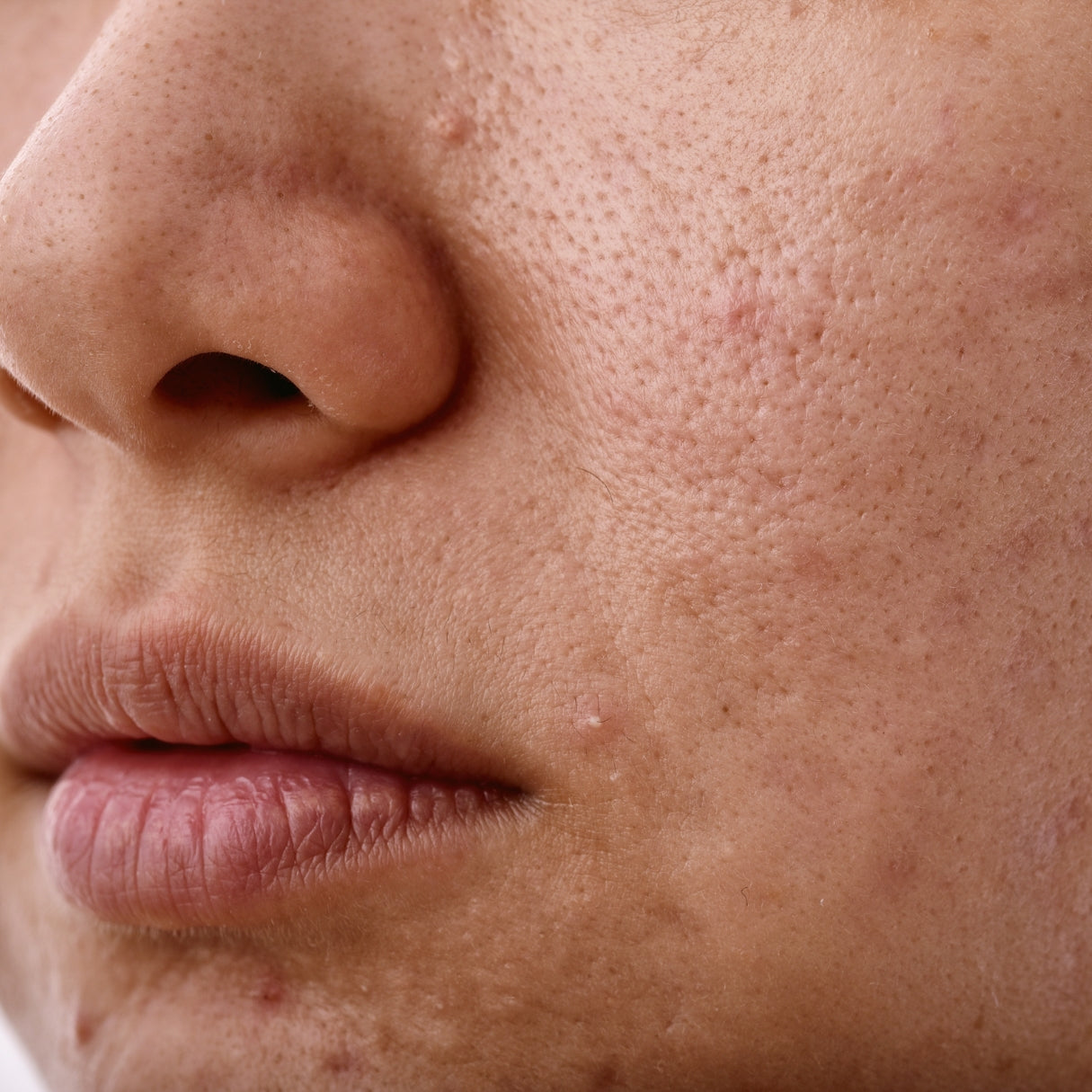 peau à imperfections