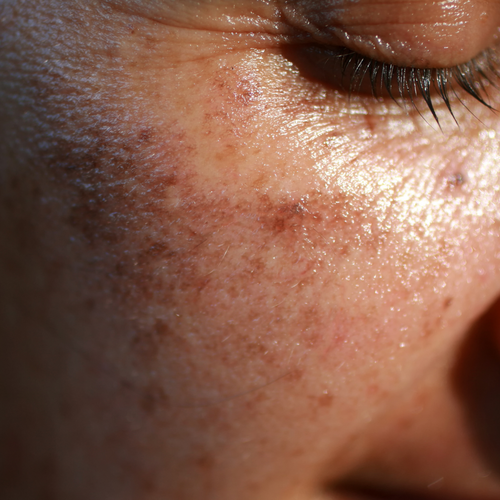 taches brunes sur le visage